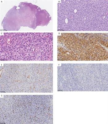 Case report: Identification of a novel heterozygous germline ERCC2 mutation in a patient with dermatofibrosarcoma protuberans